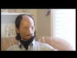 Face Transplant - YouTube