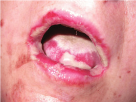 https://www.researchgate.net/profile/Nicola_Clayton2/publication/232083517/figure/fig1/AS:300582528143360@1448675867271/Lip-and-tongue-burns-on-admission.png